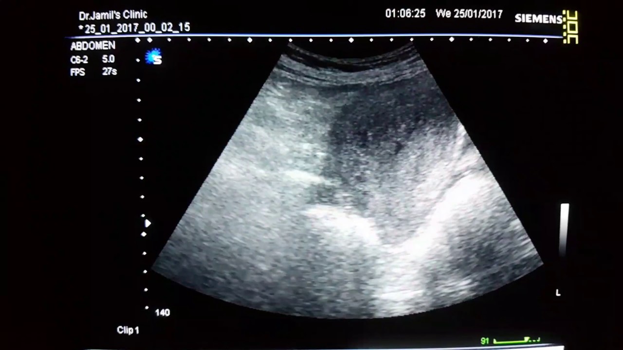 Endometritis Ultrasound