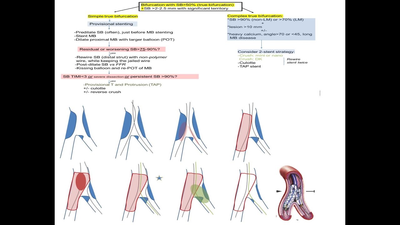 Coronary bifurcation stenting: modern algorithms and details of provisional techniques- Elias Hanna