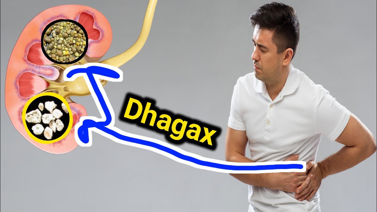 In kiliyaha dhagxaan kaaga sameeysmaan adiga ayaa sabab u ah hadii...