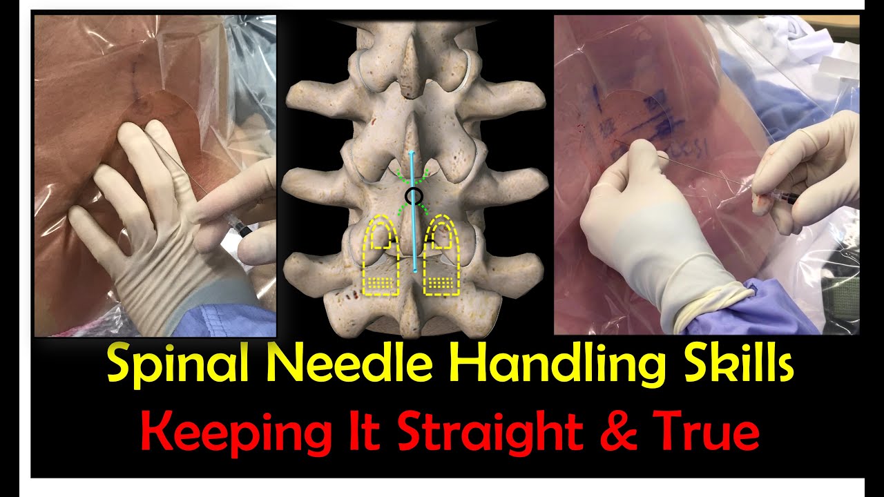Needle Handling Skills for Successful Lumbar Puncture / Spinal Anesthesia