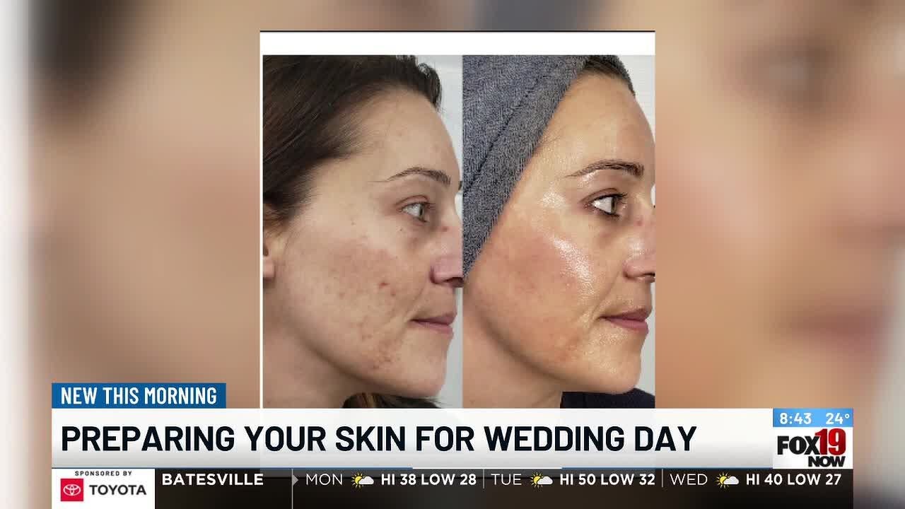 Preparing your skin for wedding day
