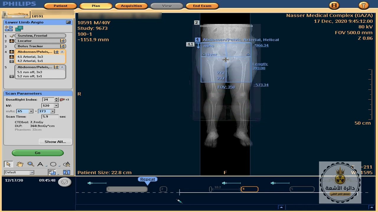 Lower Limb Angio ct on philips 64 ingunity
