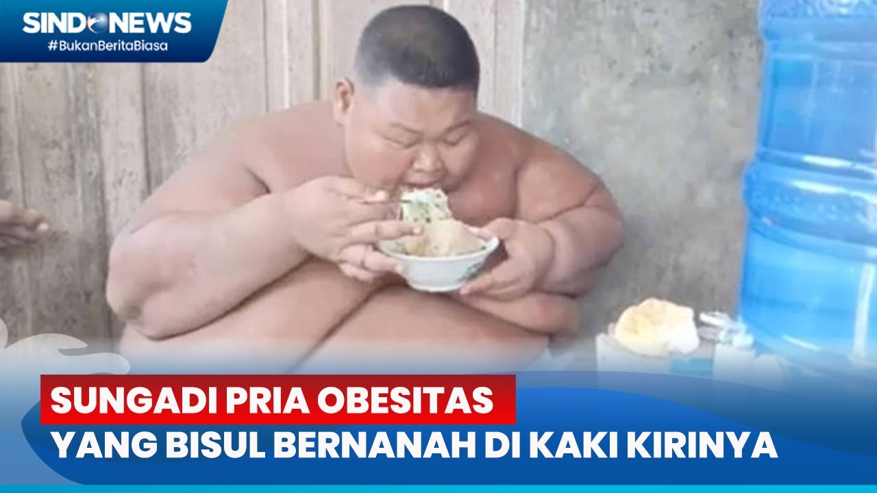 Sungadi Pria Sragen Doyan Makan: Obesitas 165 Kg, Kini Kaki Bisul Bernanah - Sindo Today 27/05
