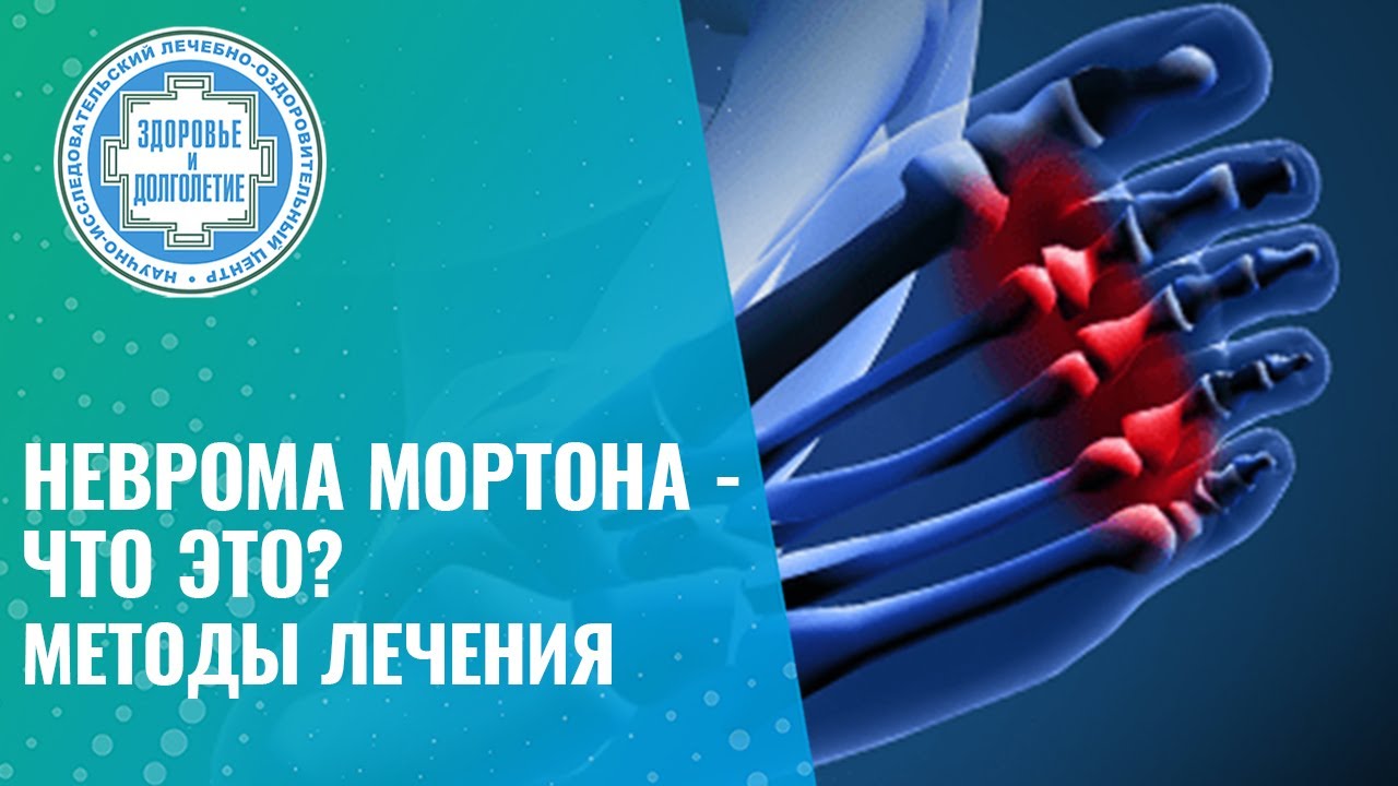 💁 🦶  Неврома Мортона - что это? Методы лечения