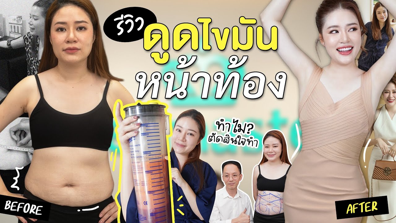 LIFESTYLE || รีวิวดูดไขมันหน้าท้อง ประสบการณ์รวม 3 เดือน ก่อน-หลังทำ || NinaBeautyWorld
