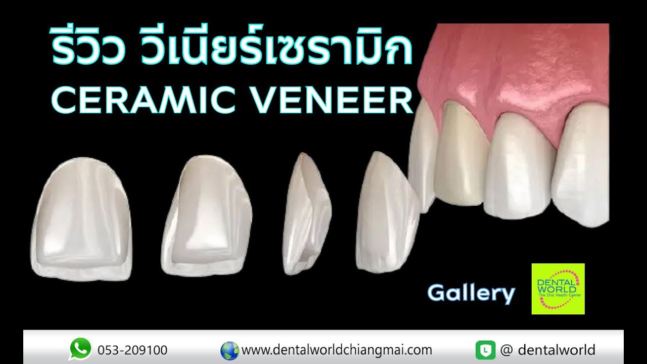 EP.62 รีวิววีเนียร์เซรามิก Ceramic Veneer Review