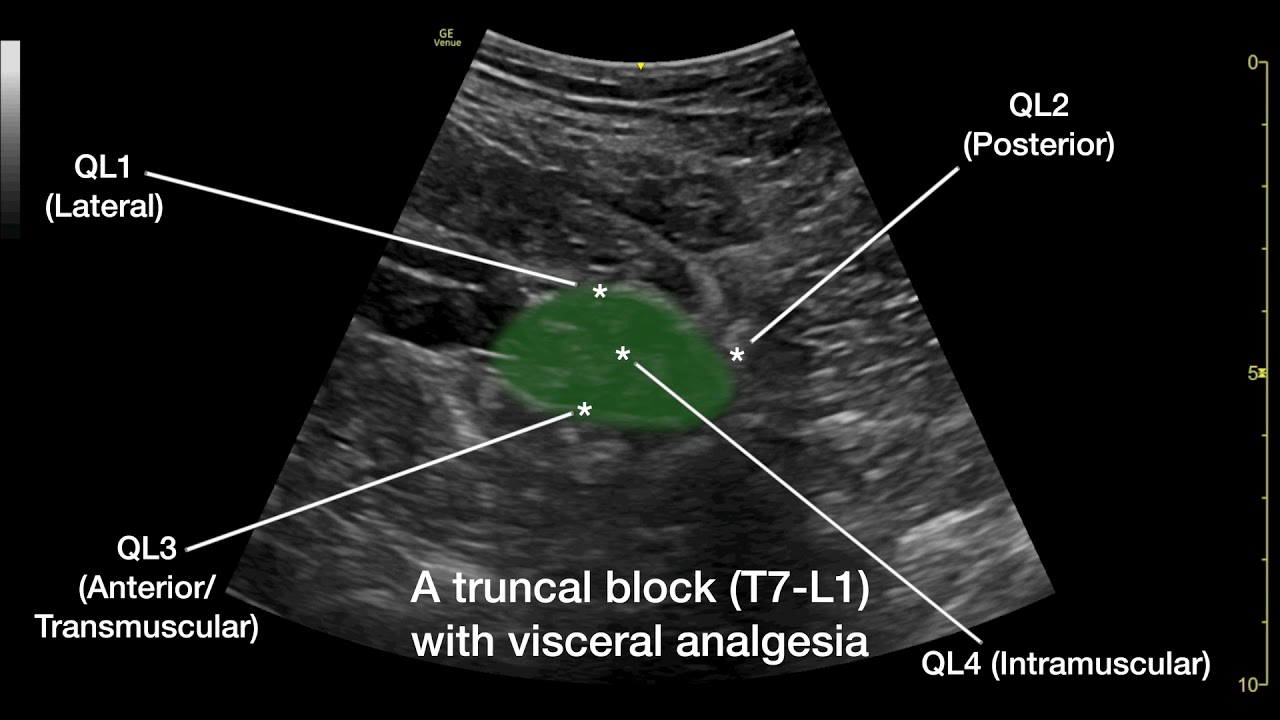 The Anterior Quadratus Lumborum (QL) Block