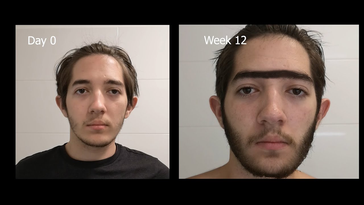 My Minoxidil SIDE EFFECTS (unwanted hair growth, itchy face, etc)