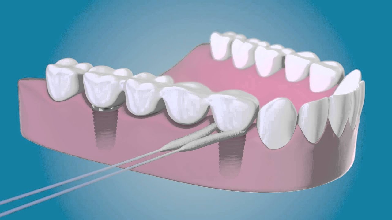 Limpie sus implantes con el Hilo TePe para Puentes e Implantes