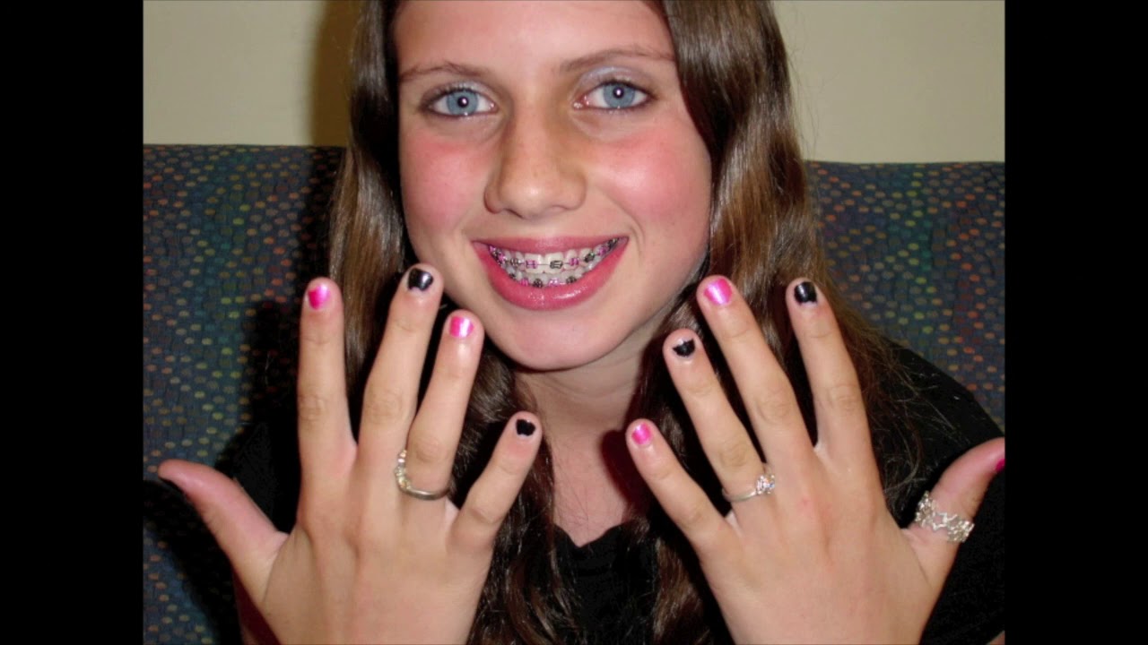 Smile Solutions Orthodontists - taking care of your braces instruction video