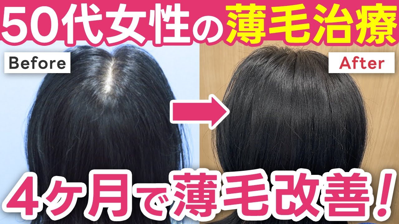 【50代女性の薄毛治療】悩んでなかったのに…4ヶ月で分け目＆つむじが劇的改善！