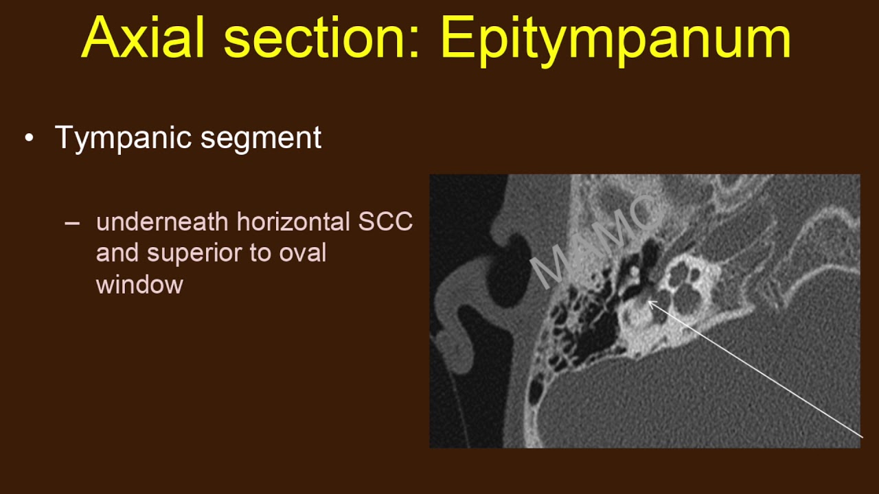 TMT: HFN by Dr Jyoti Kumar : Temporal Bone Anatomy Part I