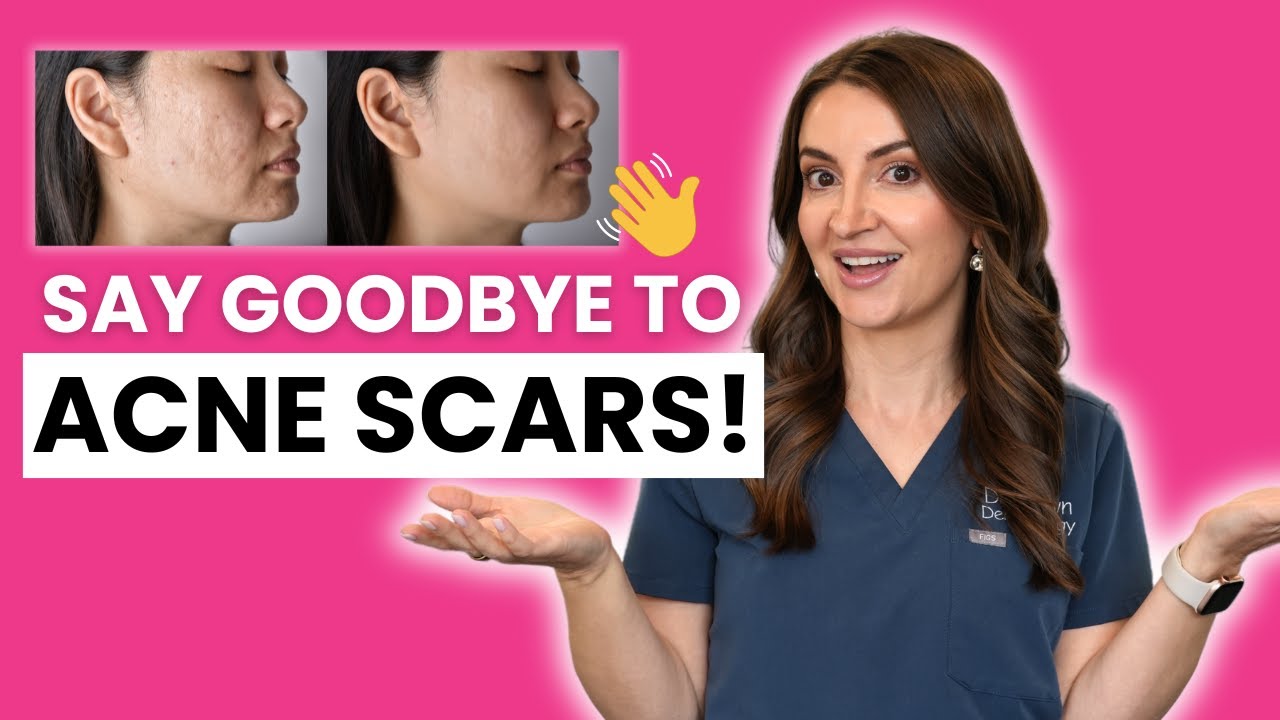 Get Rid of Acne Scars for GOOD! | Dermatologist Complete Guide to Acne Scars Treatment