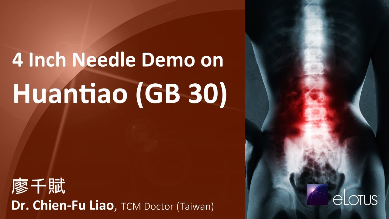 4 Inch Needle Demo on Huantiao (GB 30) with Dr. Chien-Fu Liao