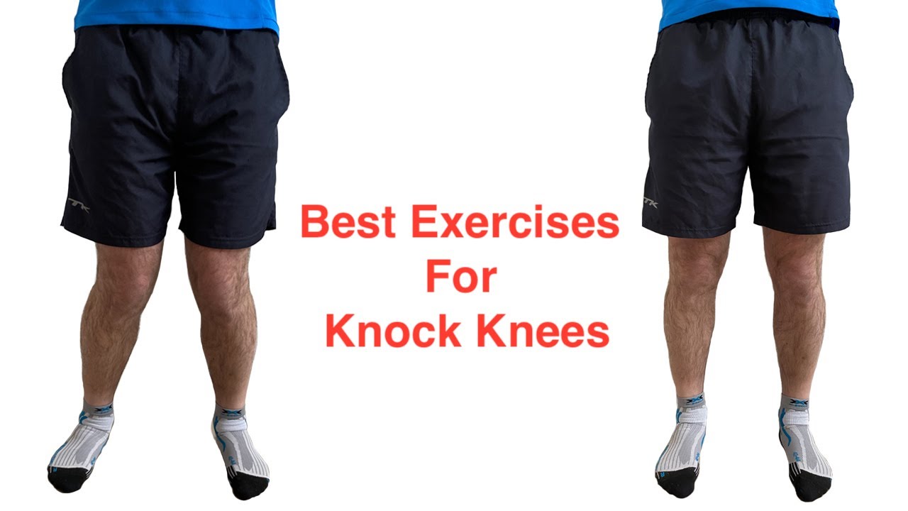 Best Exercises for Knock Knees