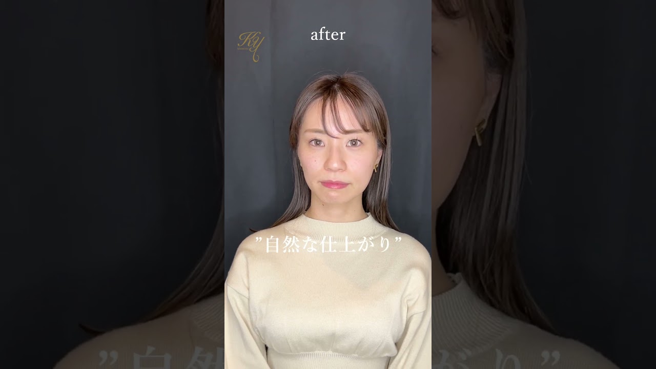 【プチ整形メニュー】顎ヒアルロン酸注入をやってみた！　#共立美容外科  #美容男子 #美容女子 #プチ整形 #美容整形 #整形 #kawaii  #メスを使わない美容整形