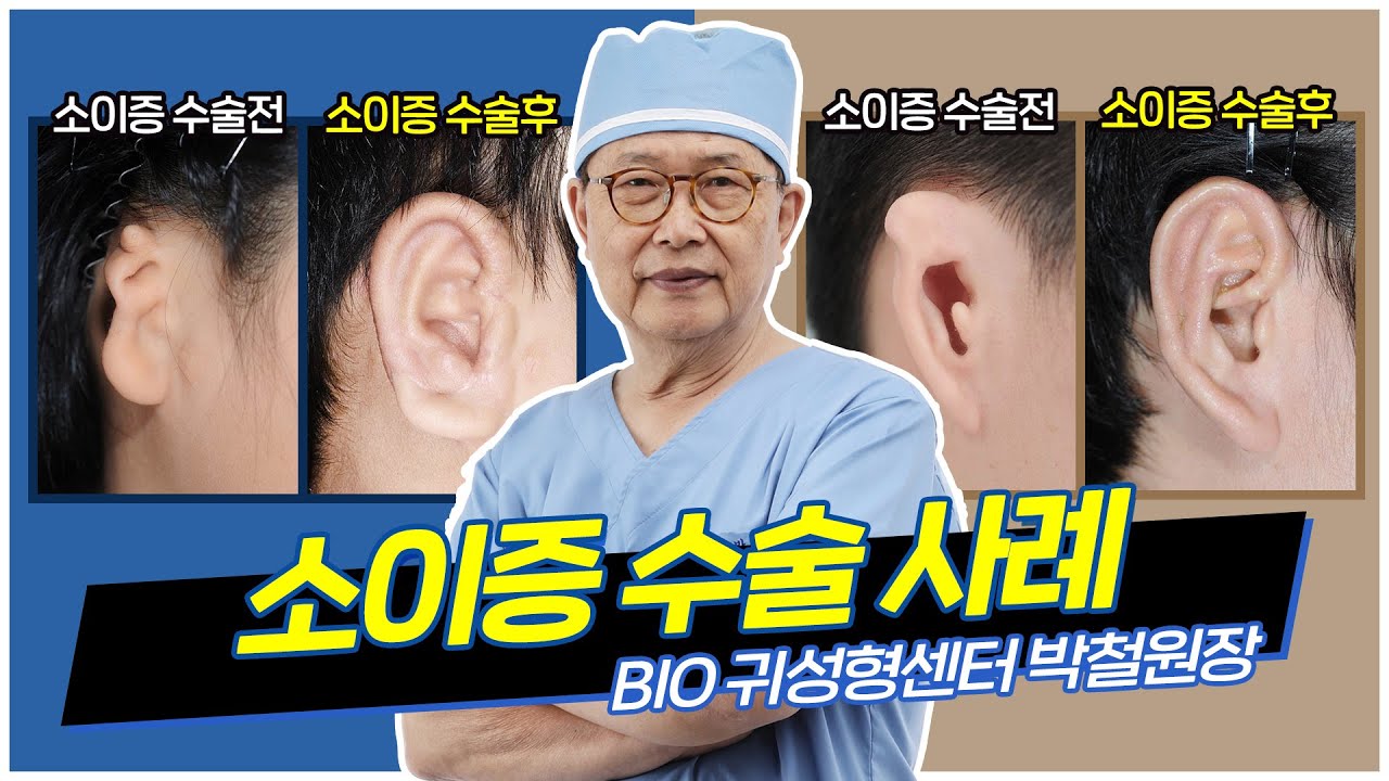 박철원장의 소이증 수술 사례 3가지 Three cases of microtia surgery by Dr. Chul Park