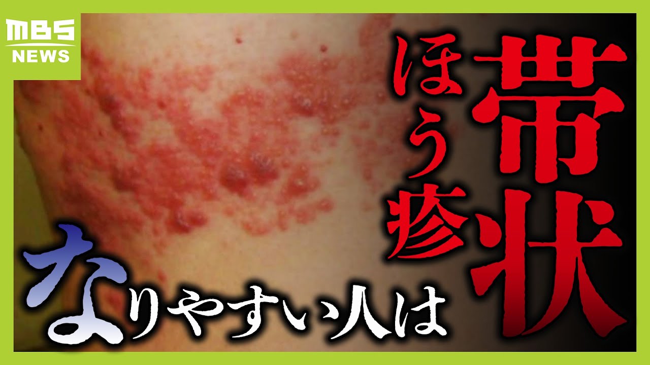 【耐えられない痛み】増加する『帯状ほう疹』若い世代も要注意！　合併症や後遺症も…どんな人がなりやすい？（2024年10月24日）