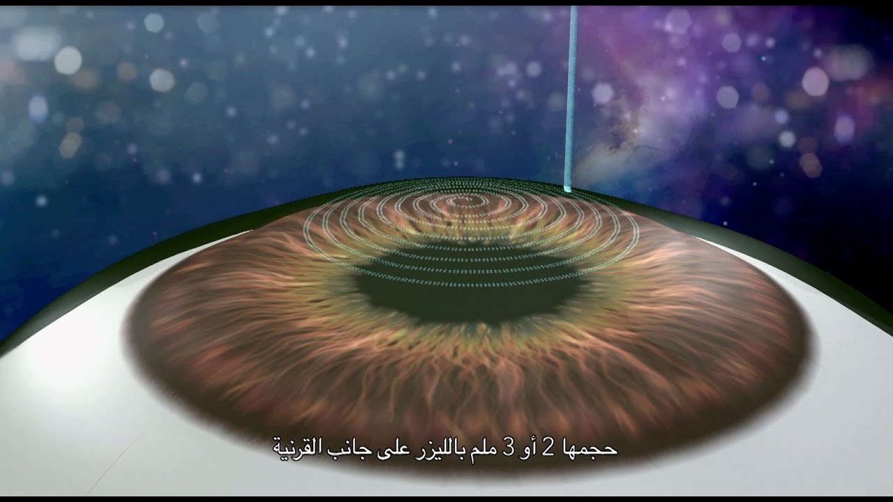 جراحة تصحيح البصر بتقنية 