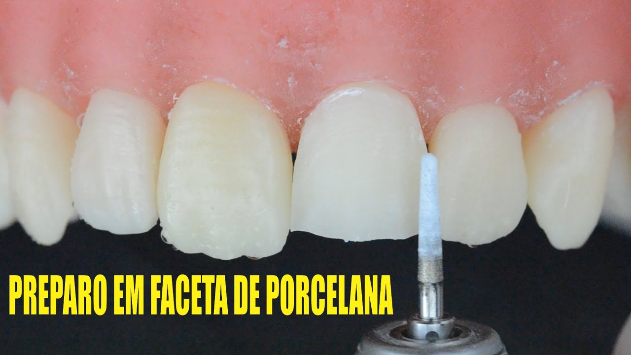 Preparo para Faceta em Porcelana