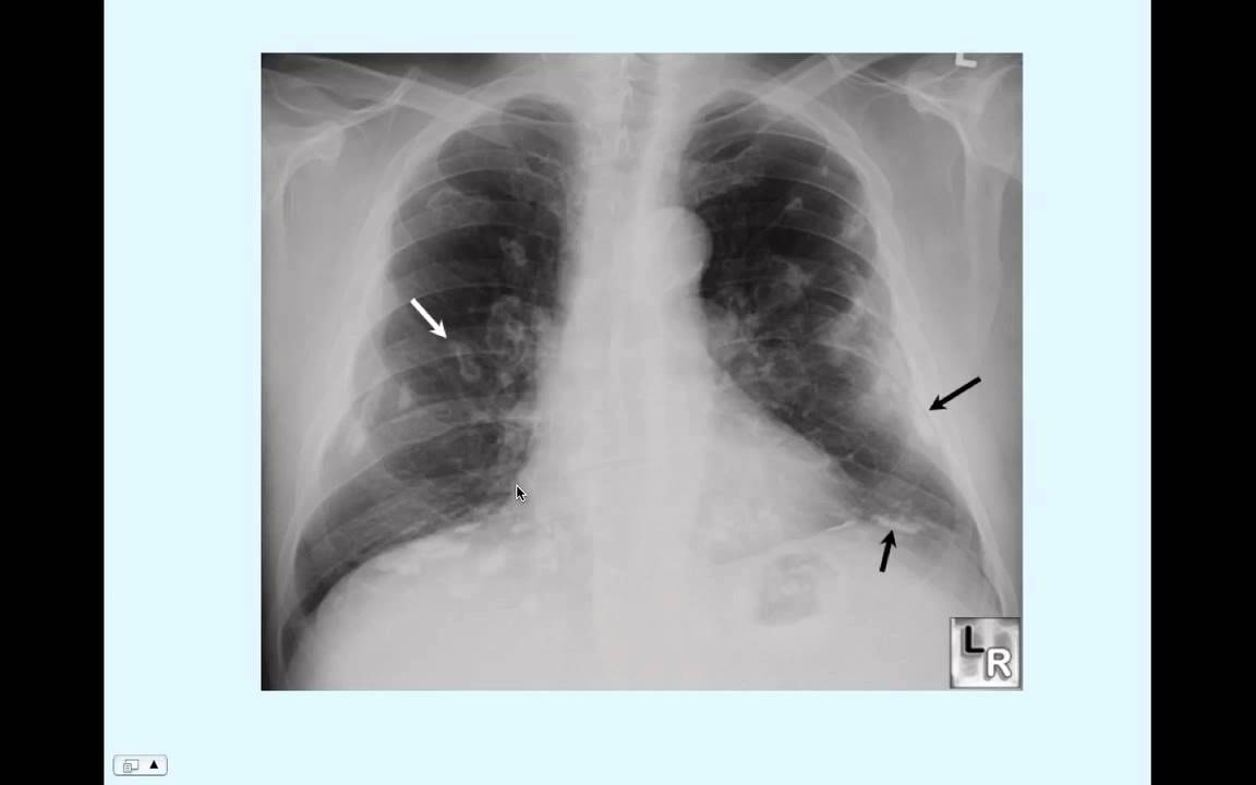 Asbestosis - CRASH! Medical Review Series