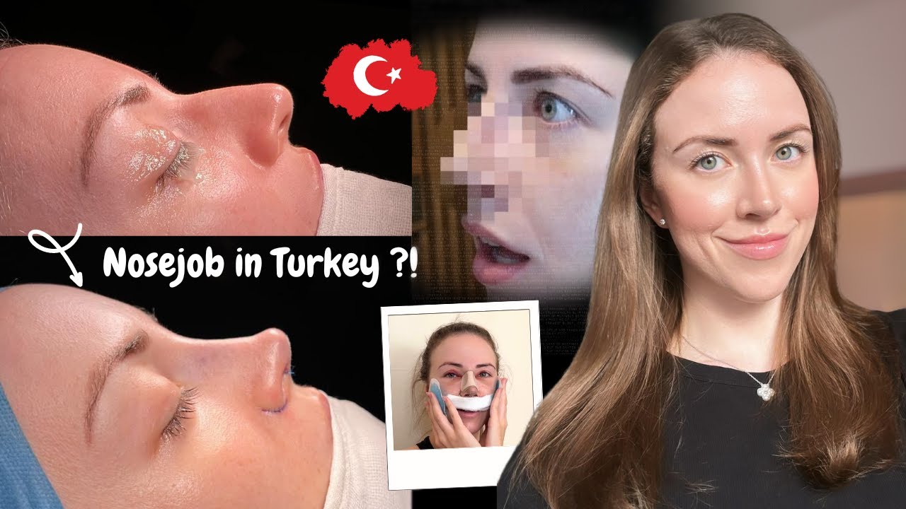 Я сделала ринопластику в Стамбуле | Видеоблог о ринопластике в Турции 2024