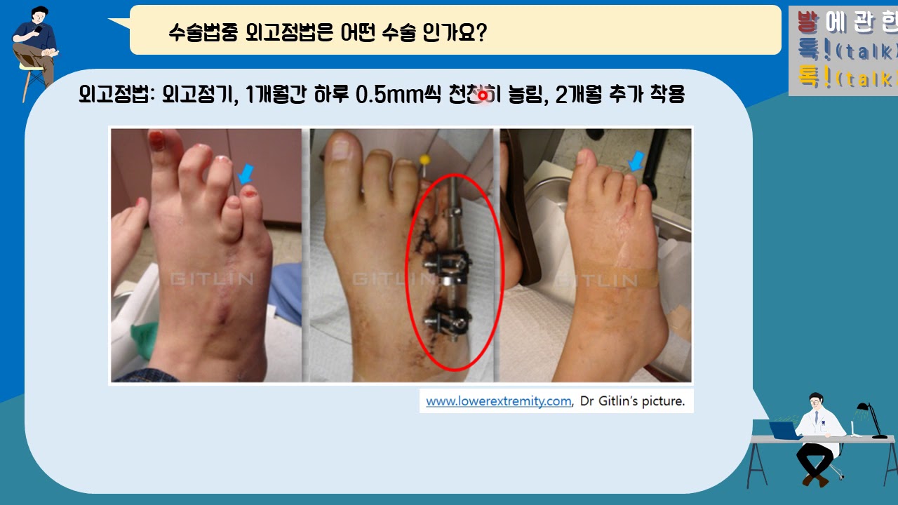 {발!톡!}, 단지증, 짧은 발가락의 수술적 치료