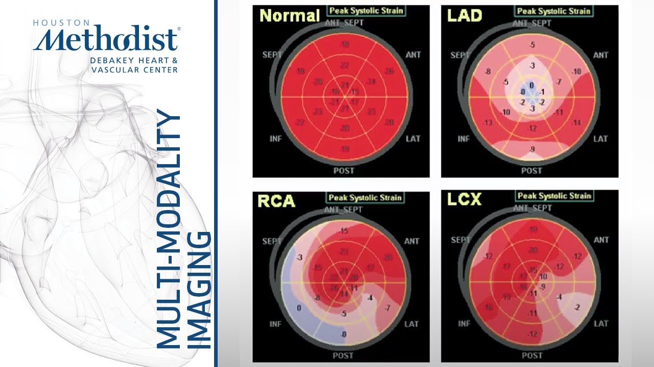 Role of Stress Echocardiography: Ischemia Evaluation and Beyond (M. Quiñones, MD) December 15, 2020