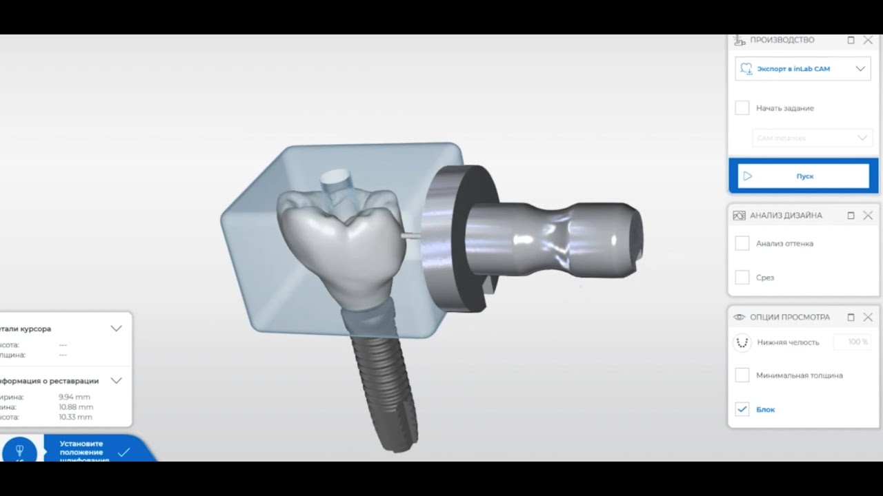 CEREC  Керамическая коронка на импланте на винтовой фиксации. CEREC DESIGN 5.1