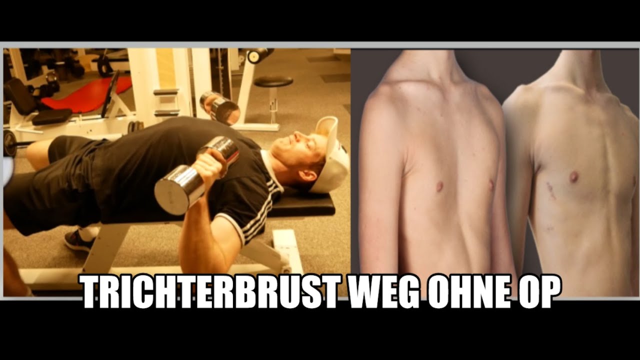 TRICHTERBRUST WEGTRAINIEREN mit diesen 5 ÜBUNGEN 💪 Training gg. Pectus Excavatum