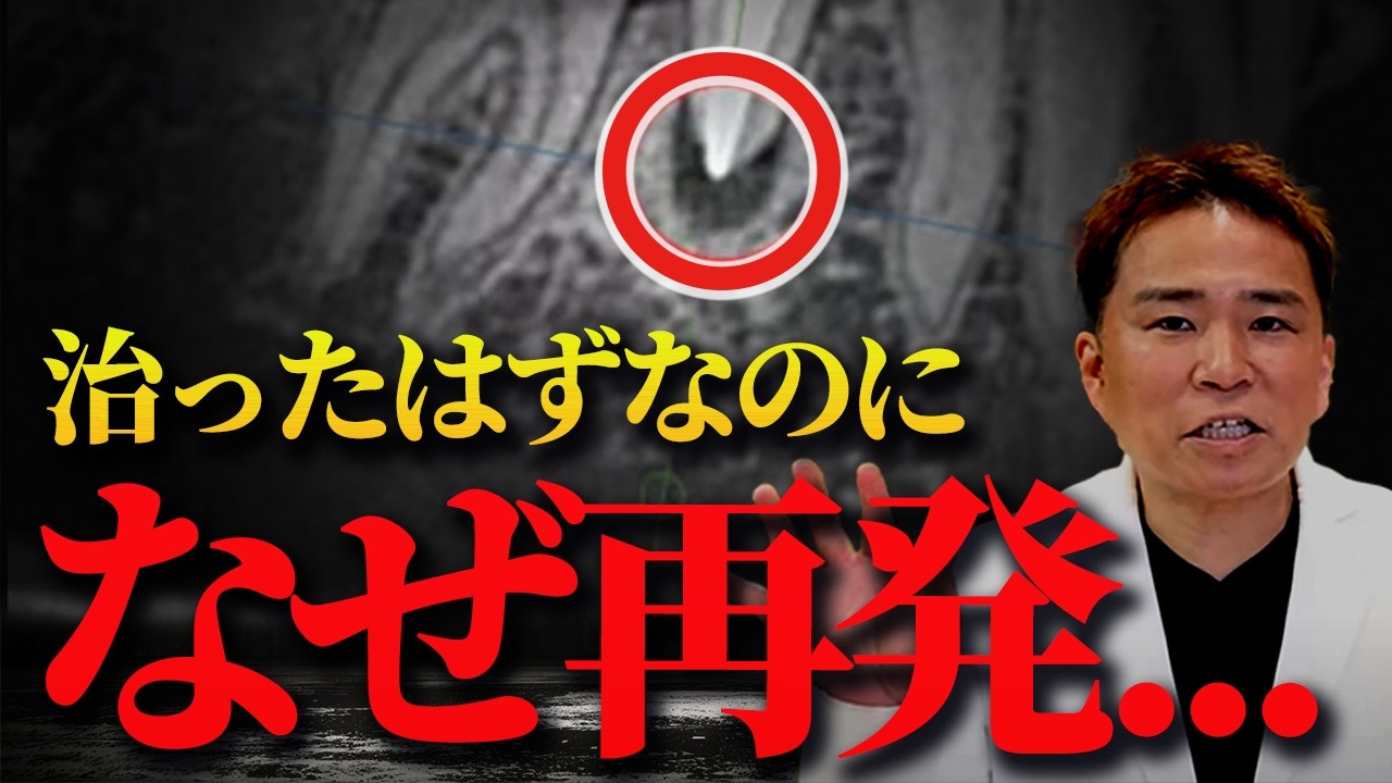 【暴露】根管治療後に膿が出てくる秘密をお話します
