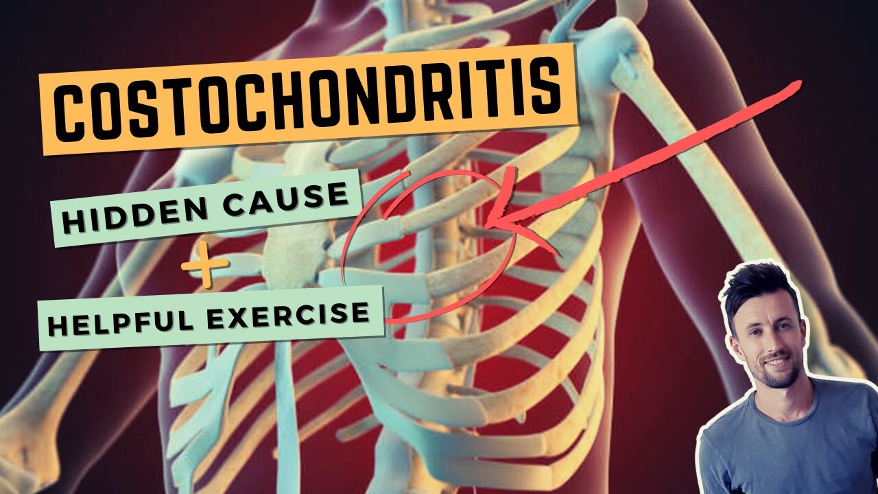 Costochondritis: The Hidden Cause and a Simple Exercise to Fix Anterior Rib Joint Pain