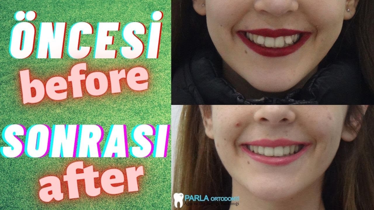 Ortodonti tedavi sonu&ccedil;ları ✔️ Diş teli tedavisi - &ouml;nce sonra / Before and After Braces Treatment