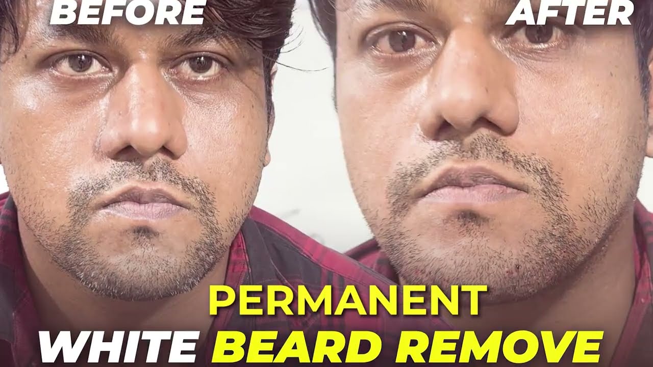 White Beard Removal Treatment | दाढ़ी के सफेद बाल हटाने की पूरी जानकारी #awishclinic #whitebeard
