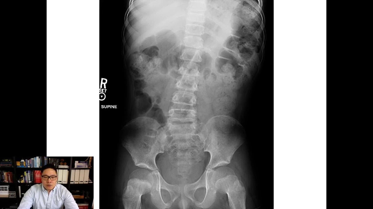 Quick Talk - Pediatric Constipation Basics