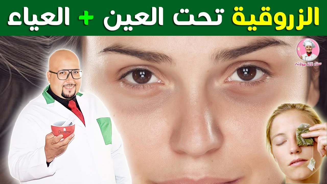 التخلص من الزروقية تحت العين + العياء || الدكتور عماد ميزاب imad mizab