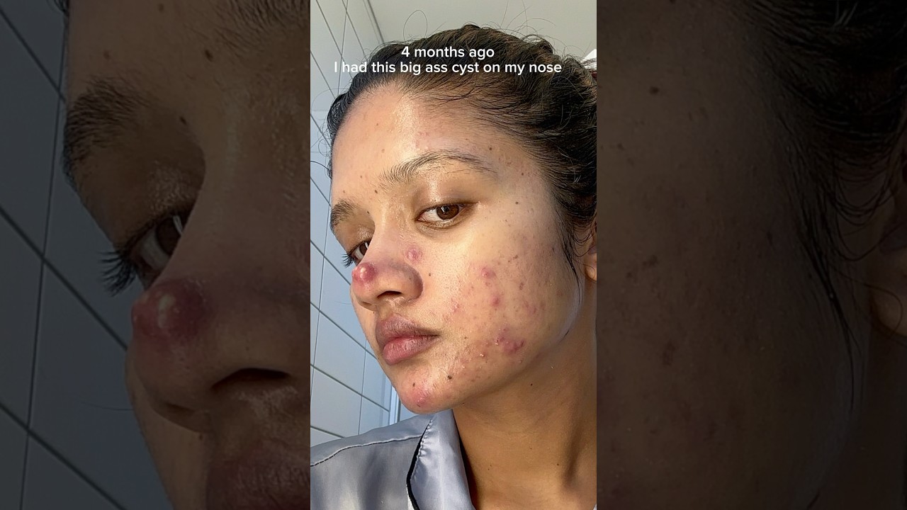 And all over my face #acne #acneproneskin #acnepositivity #cysticacne #cystic #acnejourney #acnes