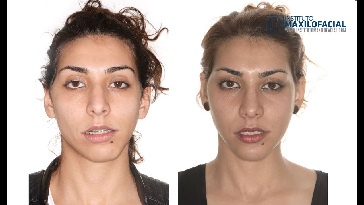 Cirugía ortognática bimaxilar. Caso #27: Silvia - Asimetría facial. Clase 2