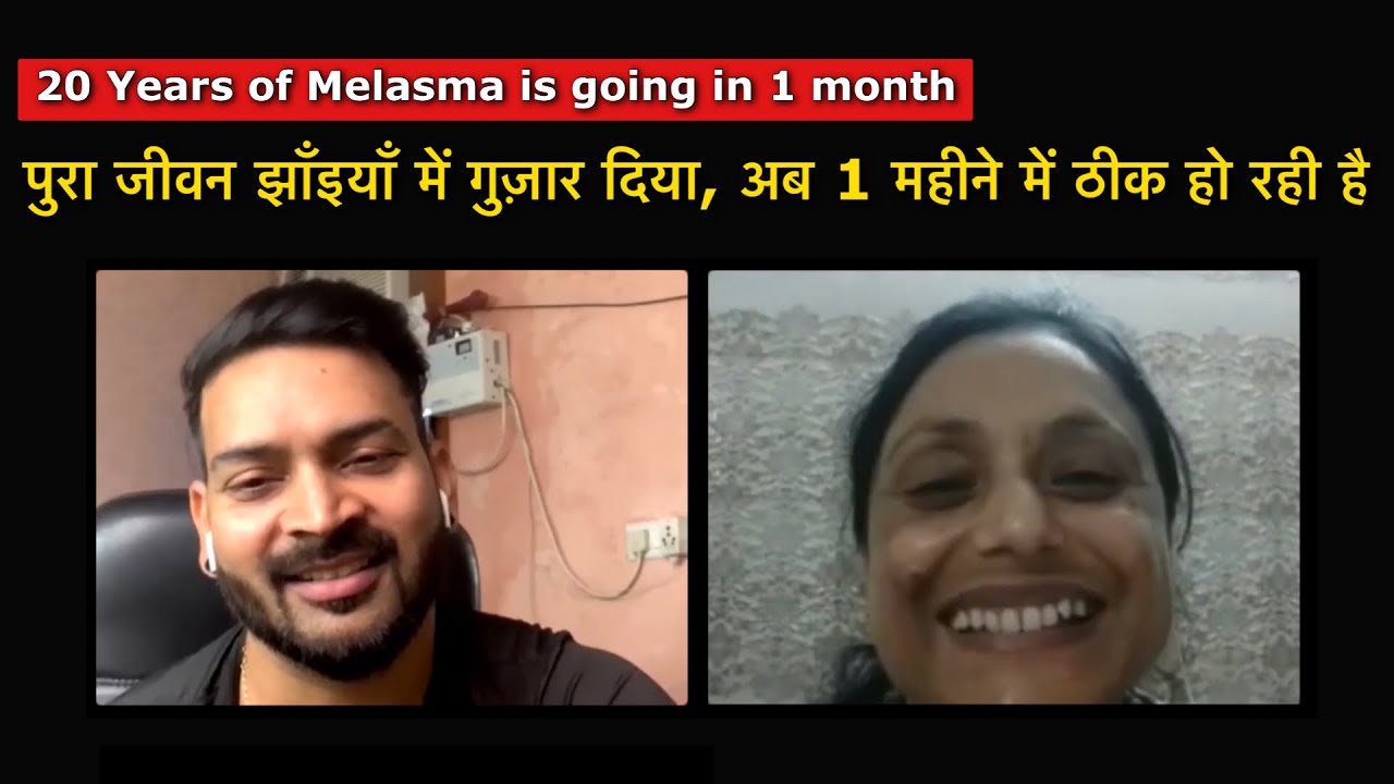 I spent all my life in Melasma. पुरा जीवन झाँइयाँ में गुज़ार दिया, अब 1 महीने में ठीक हो रही है