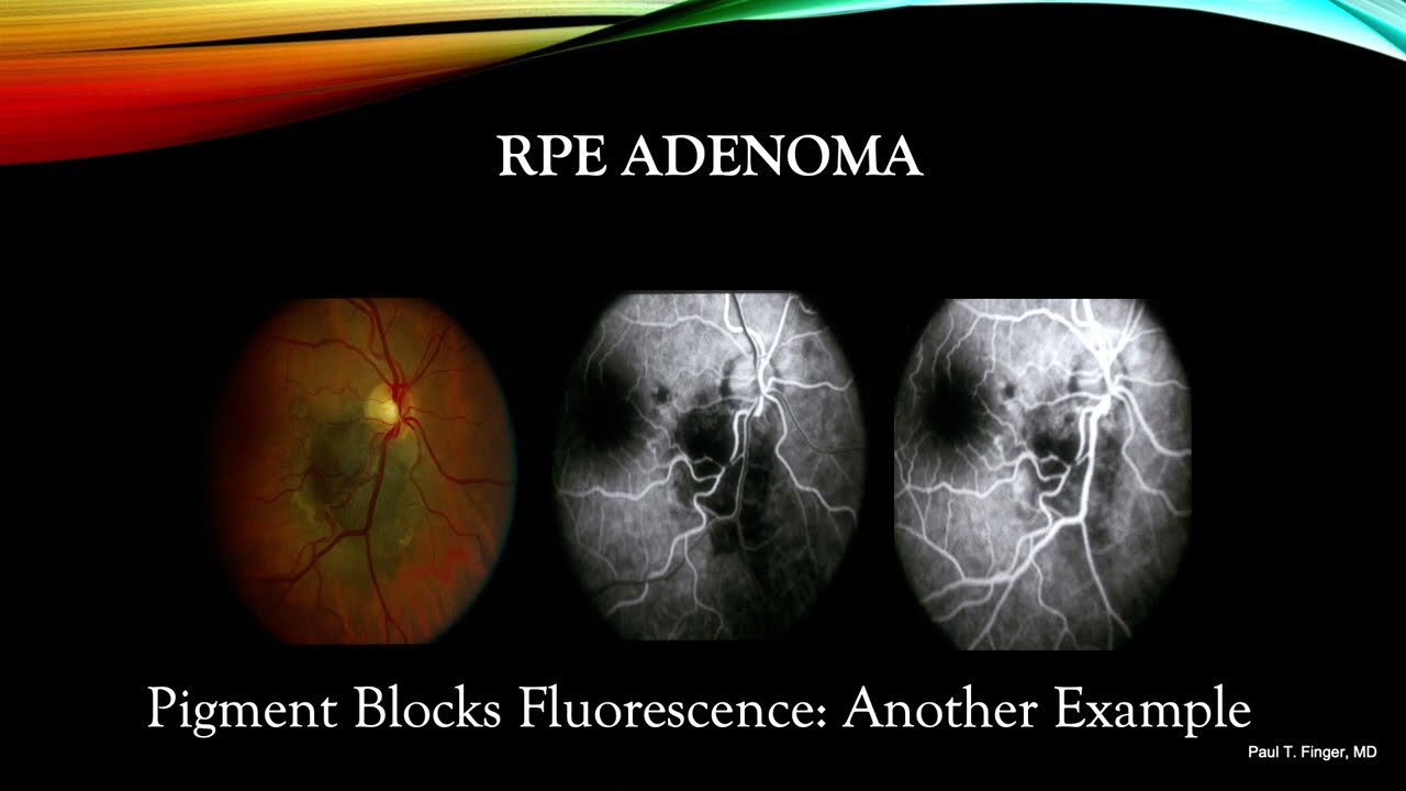 Ophthalmic Photography and Angiography: Posterior Segment Basics
