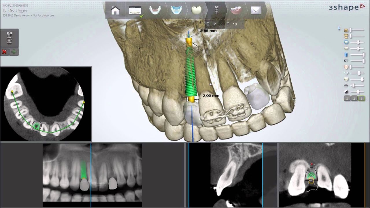 Dental System 2013 - Implant Planning and Guided Surgery