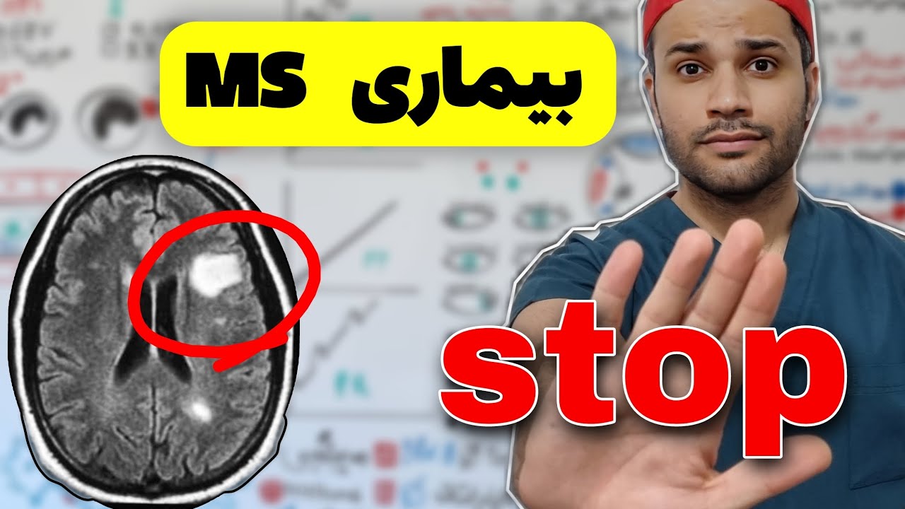 بیماری ام اس | علت | علایم | تشخیص | درمان | multiple sclerosis
