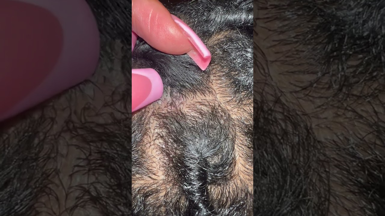 Big flake in starter locs #flakes #dandruff #asmr #scratching