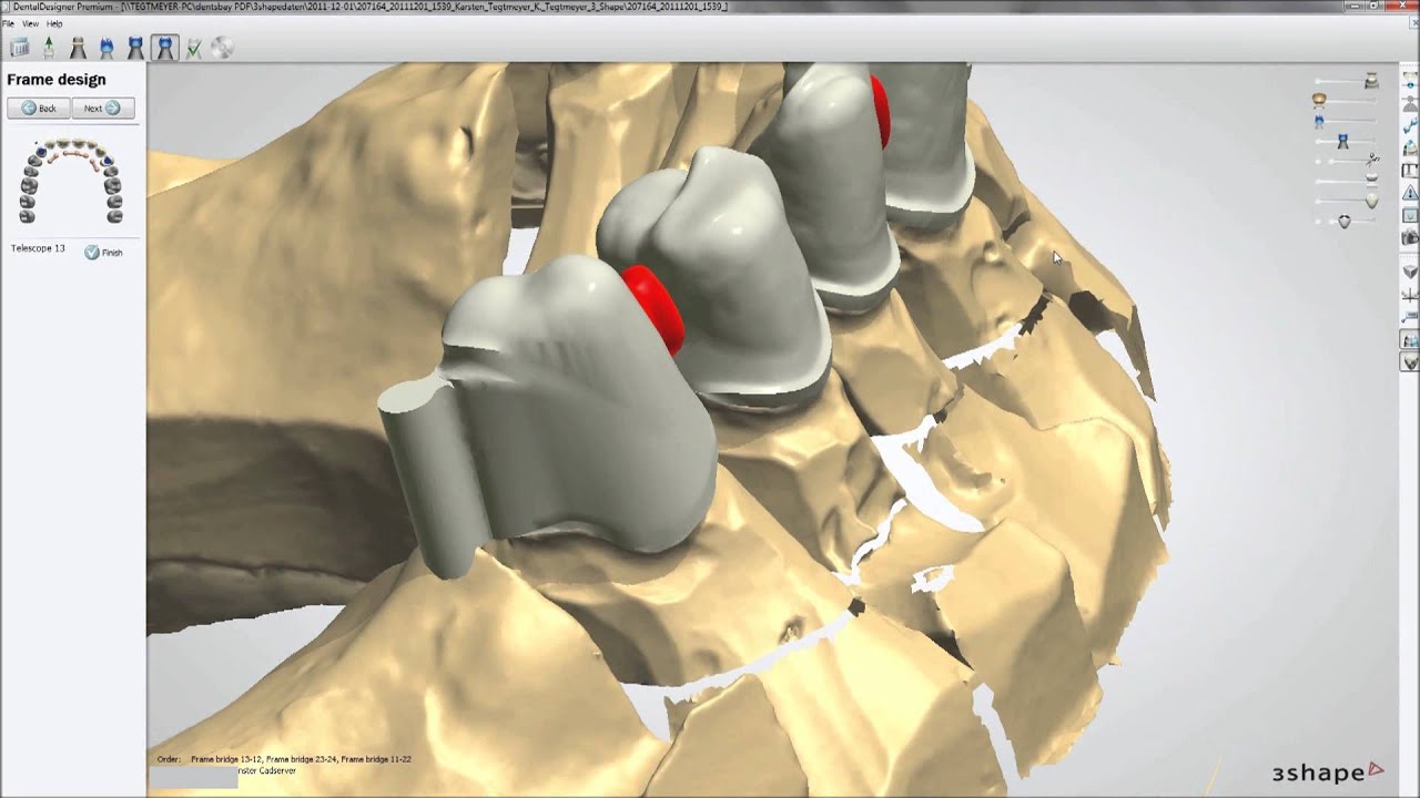 3Shape Attachment Crowns Demo