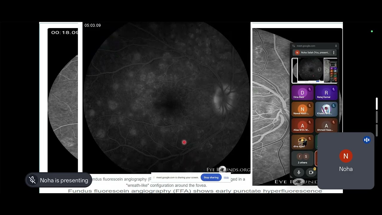 Idiopathic Chorioretinopathies