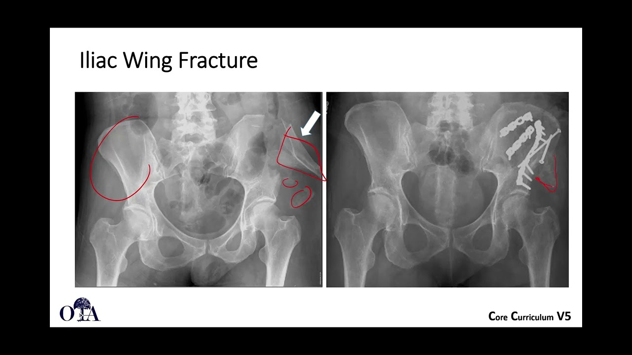 Introduction to orthopaedic trauma for OR staff - 3 of 3