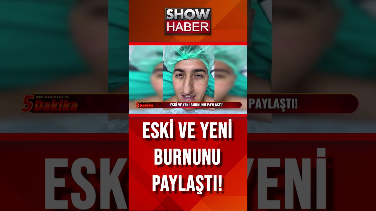 Eski ve yeni burnunu paylaştı! #showanahaber #shorts  #uguralaattinogluile5dakika