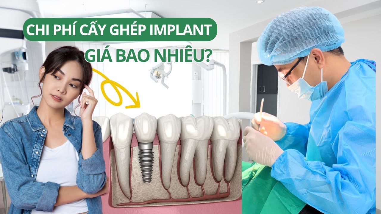 Trồng răng Implant hết bao nhiêu tiền? Chi phí cấy ghép implant nha khoa? Nha khoa Green Life