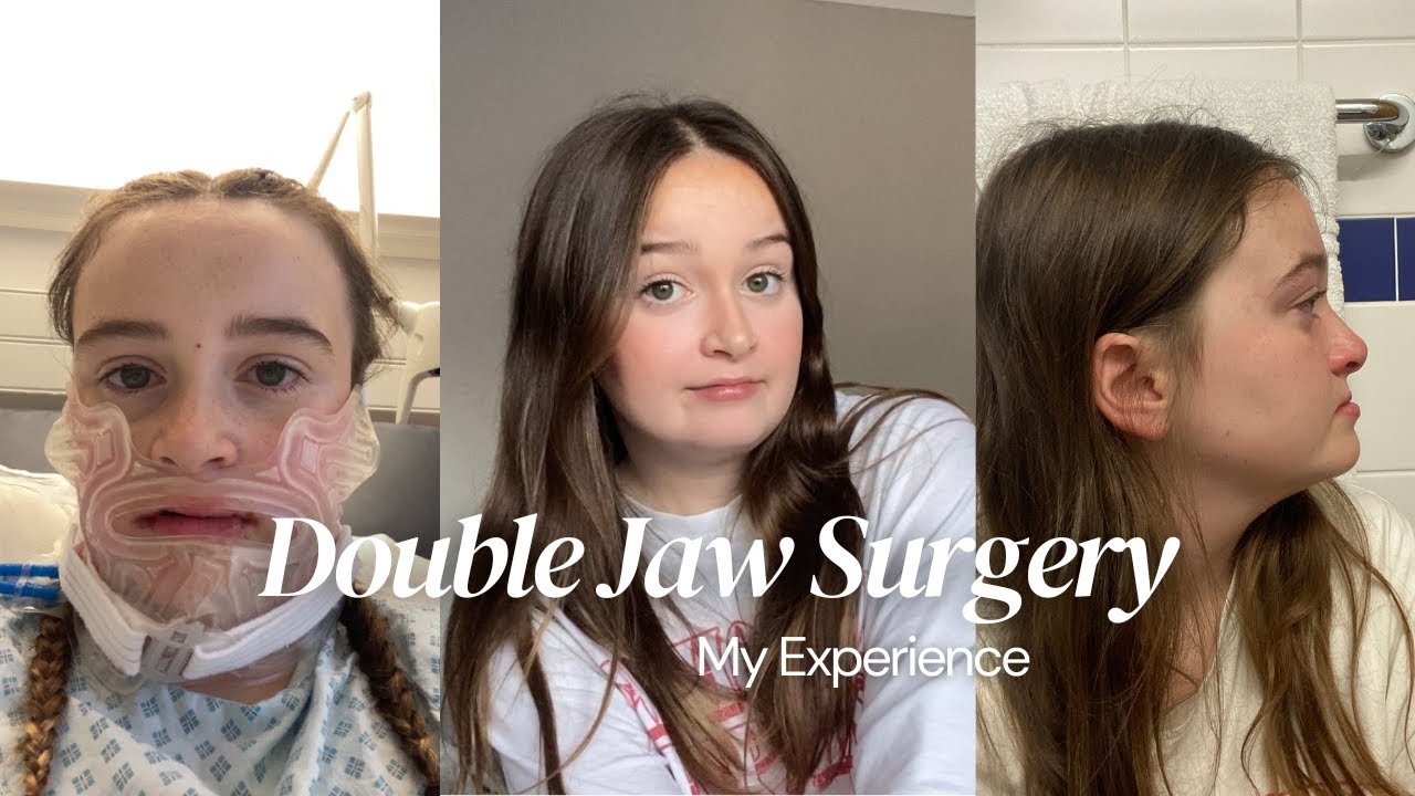 My double jaw surgery experience