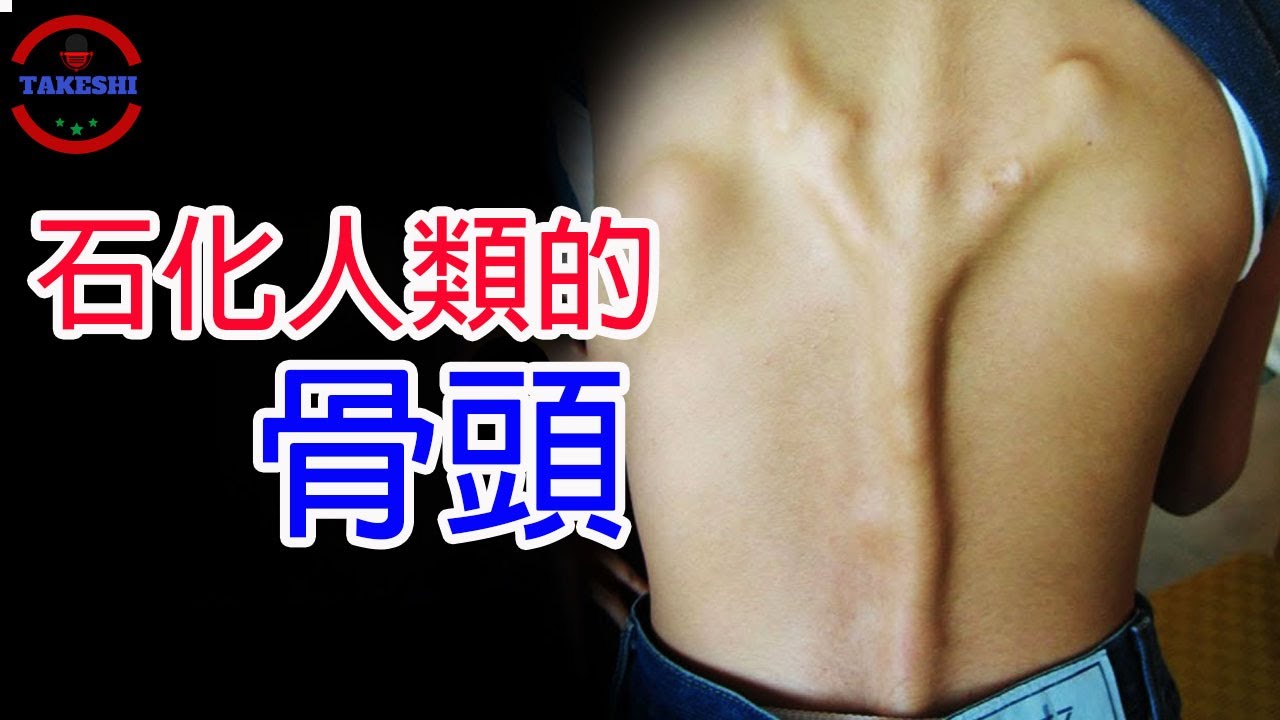 [生物放大鏡] 極罕見疾病 被梅杜莎詛咒的